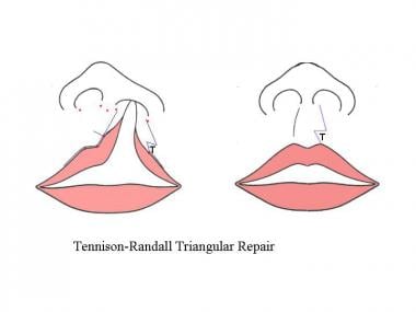 Tennison-Randall repair. The medial lip element is