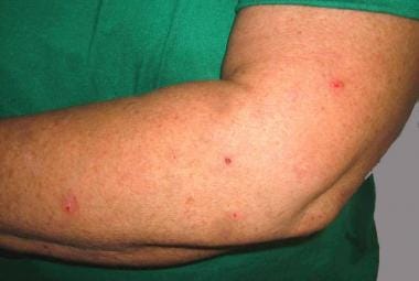 Subtle excoriations on the dorsal forearm of a mid