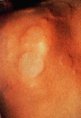 Local urticaria on a patient with latex allergy wh