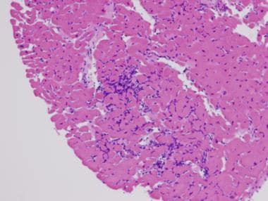 Myocarditis. Hematoxylin and eosin staining. Low p