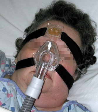Noninvasive ventilation with bilevel positive airw