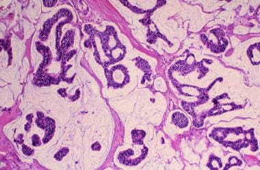 Breast cancer. Colloid (mucinous) carcinoma. Nests