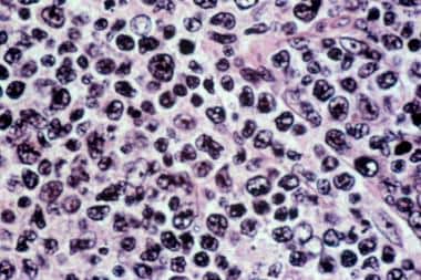 Diffuse large B-cell lymphoma. Hematoxylin and eos