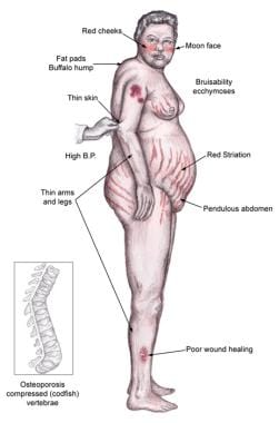 Endogenous Cushing Syndrome Background Pathophysiology Etiology