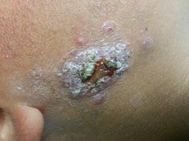 Ulcerated lesion in the cheek of a child. Note the