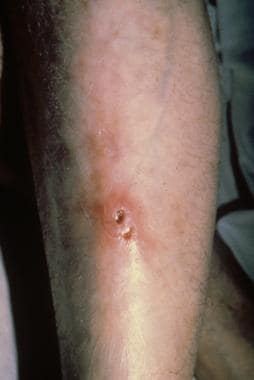 Ulceroglandular tularemia on an extremity. Courtes