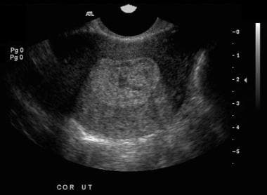 Ultrasonogram shows markedly heterogeneous and thi