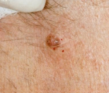 Pigmented basal cell carcinoma. 