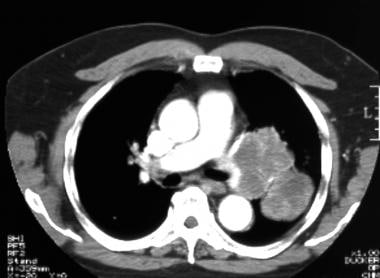 Lung cancer, small cell. Contrast-enhanced CT scan