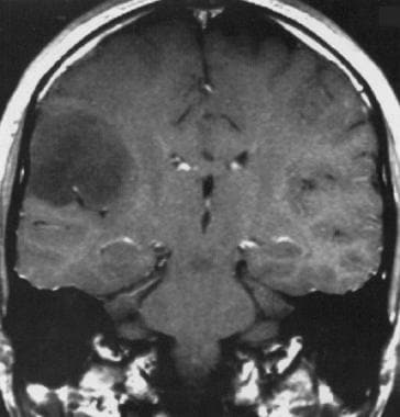 Coronal postcontrast T1-weighted MRI shows a low-g