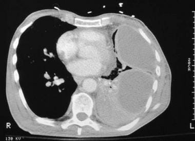 CT scan of thorax shows loculated pleural effusion