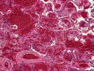 Histopathology of alveolar hemorrhage in alveolar 
