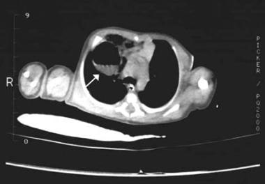 CT scan of child (same patient as in Image above) 