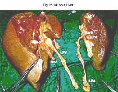 Liver transplantation. Split liver. 