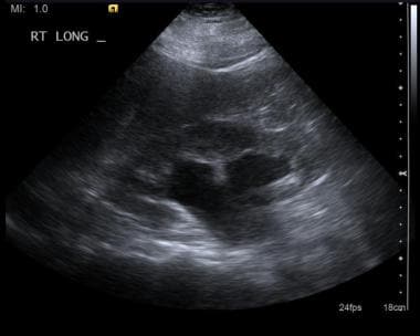 Longitudinal image of right kidney displaying mode