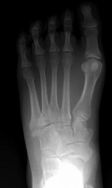 Comminuted navicular fracture in a young drunk dri