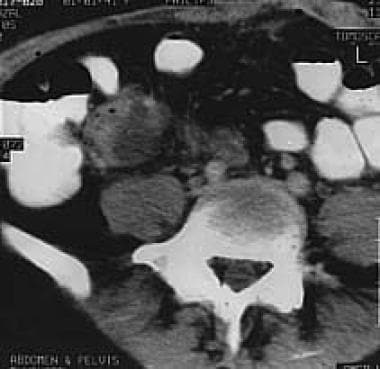 CT scan of abdomen and pelvis showing a urinoma. 