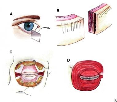 A: The lower eyelid has been cross-sectioned in or