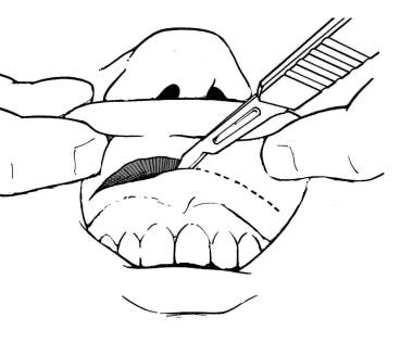 Nasal and Sublabial Approaches to the Pituitary Treatment & Management ...