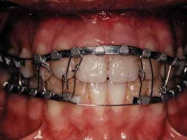 Maxillomandibular fixation using arch bars retaine
