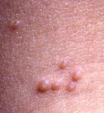 A 14‐year‐old girl with grouped flesh color papules and skin color