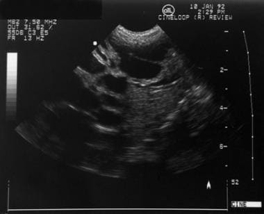 Hepatic ultrasonogram of a neonate with Caroli dis