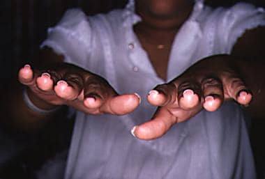 Hyperconvex nails in Turner syndrome. Note U-shape