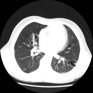 Follow-up CT scan of the thorax (lung windows) of 