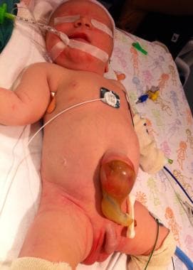 Pediatric omphalocele and gastroschisis (abdominal