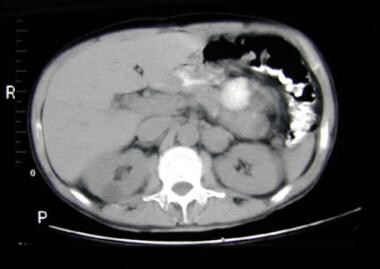 Abdominal CT scan demonstrating left suprarenal ma