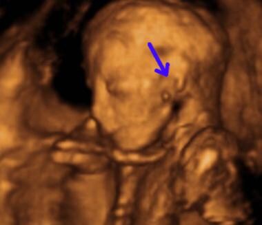 Three-dimensional sonogram of fetus with microtia.
