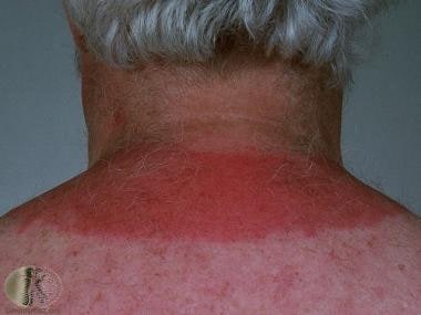 Solar Urticaria: Practice Essentials, Epidemiology, Etiology