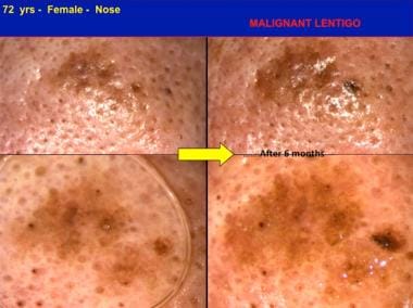 In situ melanoma, malignant lentigo type, detected