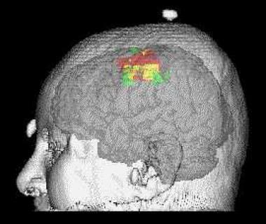 Example of a motor map obtained by transcranial ma