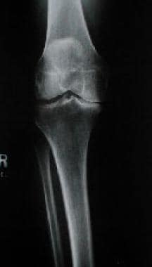 Preoperative radiograph of varus-aligned knee with