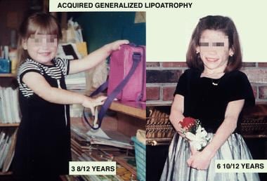 Generalized Lipodystrophy. Acquired generalized li