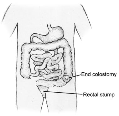 Illustration of segment of distal colon that would