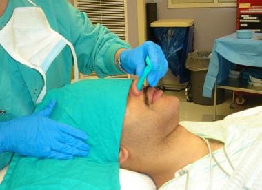 Nasal trumpet insertion (continued). 