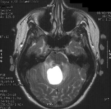 MRI of a 48-year-old woman with progressive unstea