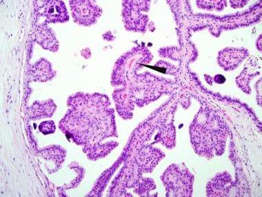 intraductal papilloma emed