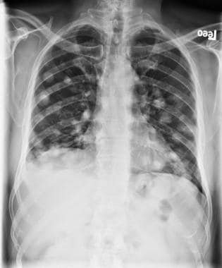 Chest radiography of patient with metastatic melan