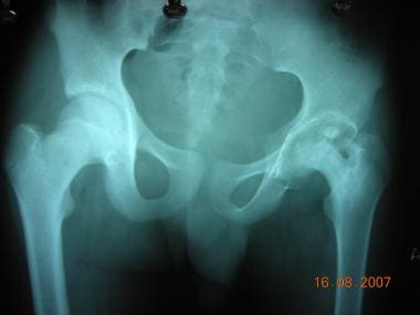 Destruction of proximal femoral epiphysis as conse