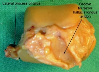 Posterior surface of the talus bone. 