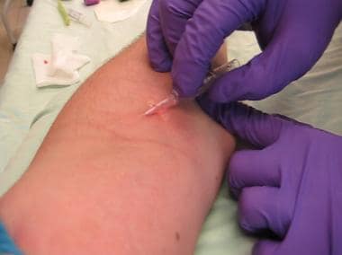 Sliding hub of catheter over needle and into vein 
