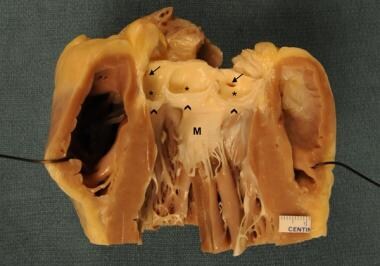 Longitudinally opened, left side of a heart showin