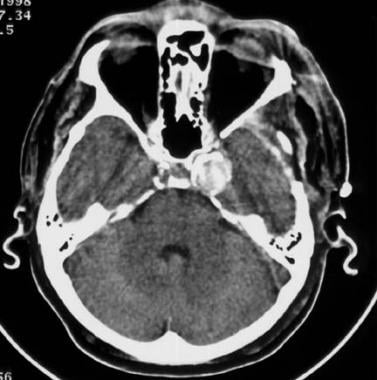 Nonenhanced CT scan of a middle-aged man with head