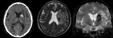 Noncontrast CT of the brain (left) demonstrates an