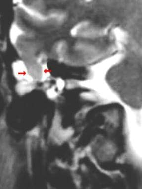 Coronal fast spin-echo T2-weighted image demonstra