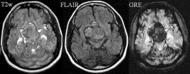 The subarachnoid hemorrhage appears hyperintense o