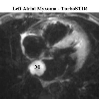 Turbo short-tau inversion recovery (STIR) MRI scan